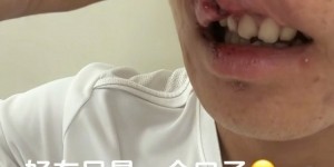 玉昆后卫晒受伤照：提前换下因争头球撞到了 视野模糊看不清&amp;amp;头晕